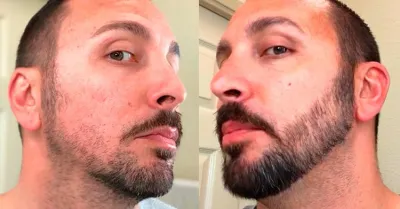 Як вибрати найкращий Minoxidil для росту волосся